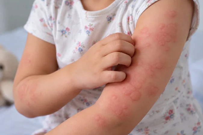 Chronic Urticaria