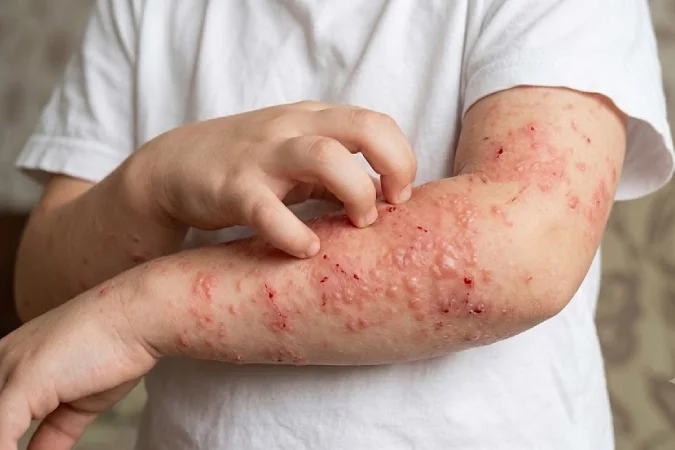 Skin Allergies and Rashes