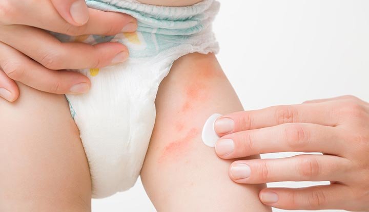 diaper rash